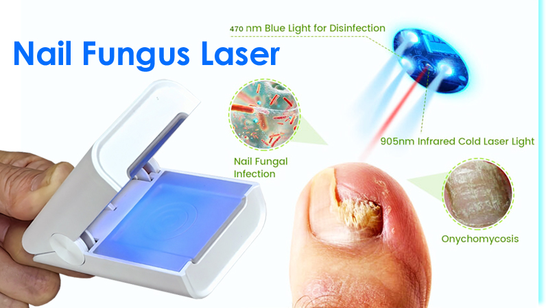 Fungal Nail Treatment Laser Device For Nail Fungus Removal Anti Infection Paronychia Onychomycosis Care