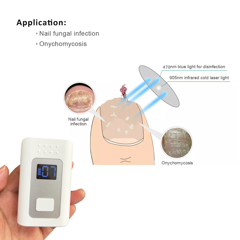 Toenail fungus laser at home
